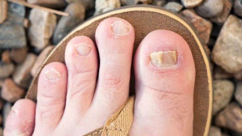 Fungal diseases of nails