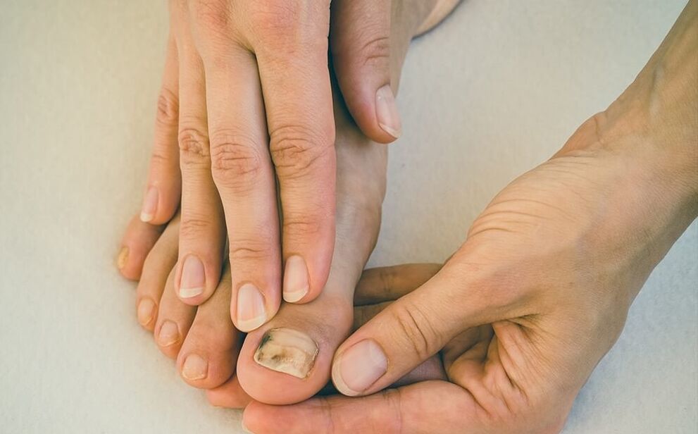 How Toenail Fungus Is Treated