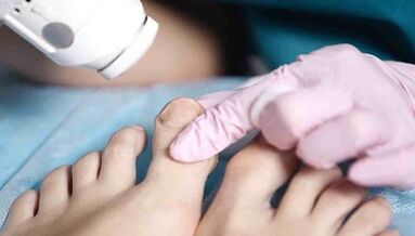 Hardware treatment of fungi on legs