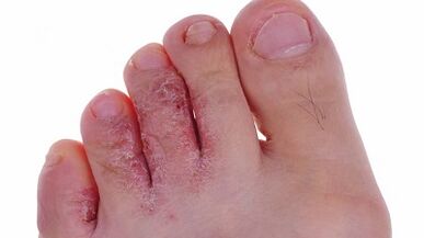 Types and stages of fungi on the legs