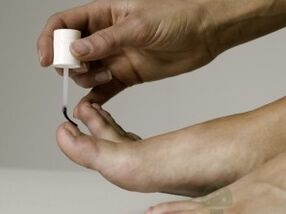 Treatment of nail fungi