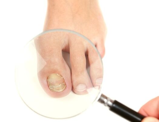 Onychomycosis