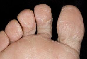 Symptoms of skin fungus on feet