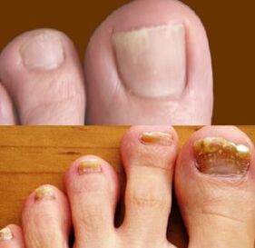 The early and late stages of foot fungus
