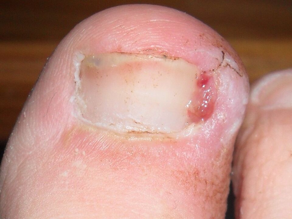 Ingrown toenails are symptoms of fungal infection