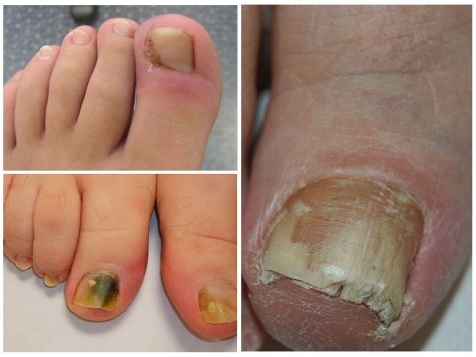 toenail fungal infection