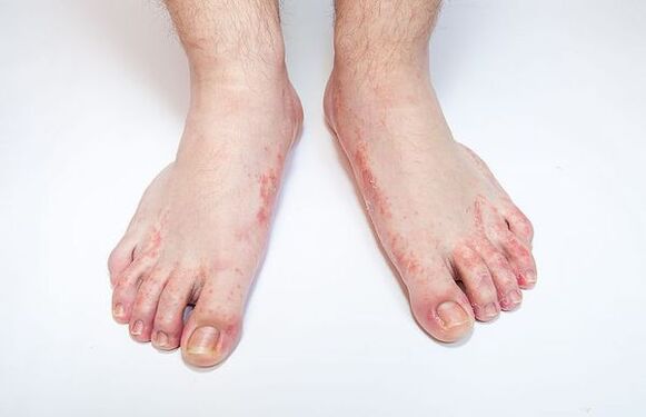 Dermatophytosis of feet