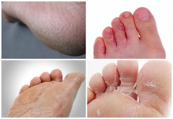 The main symptoms of fungal diseases on the feet are skin keratosis, cracking, and peeling.