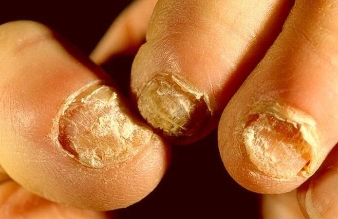 How to Treat Onychomycosis