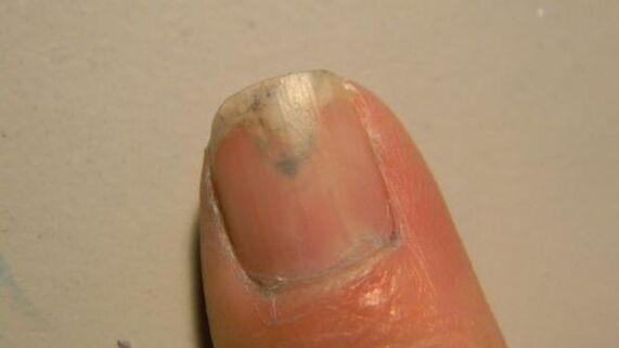 Onychomycosis symptoms