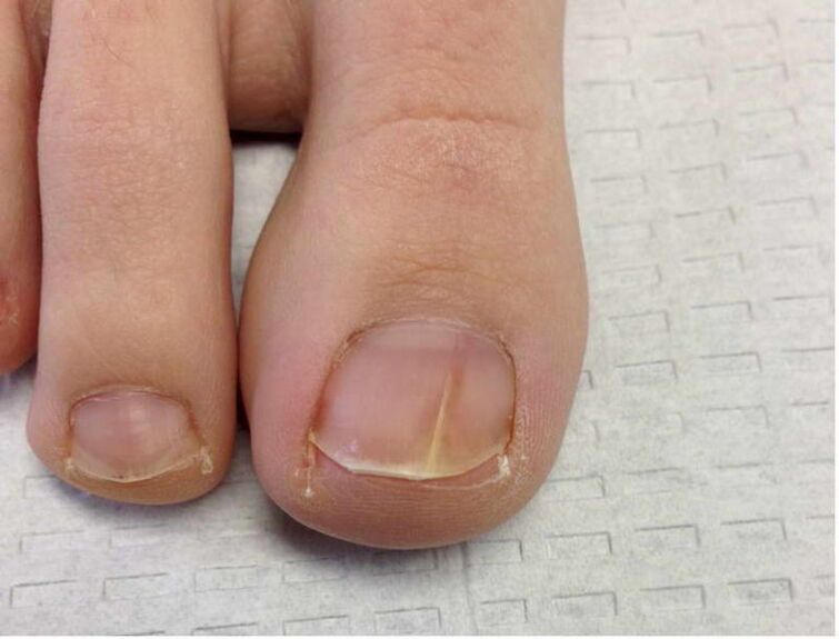 deck fungal infection