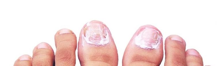 fungal nail polish