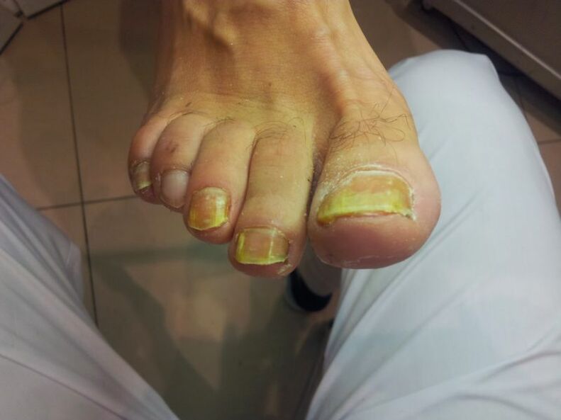 Yellow toenails due to fungus