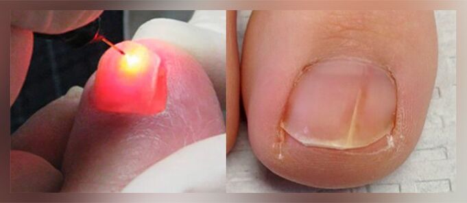 laser treatment