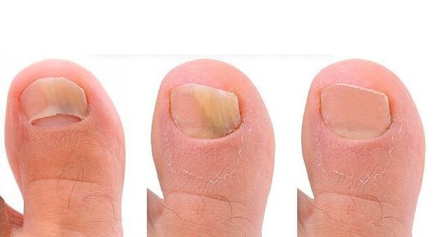 Stages of development of toenail fungus