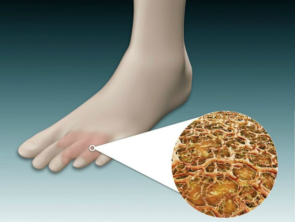 Redness of the skin between and near the toes due to intertriginous fungus